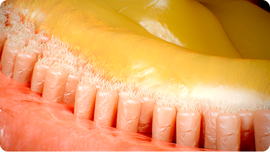 Illustrating the impact of bronchiectasis: a graphic of the insides of a bronchus with an accumulation of mucus